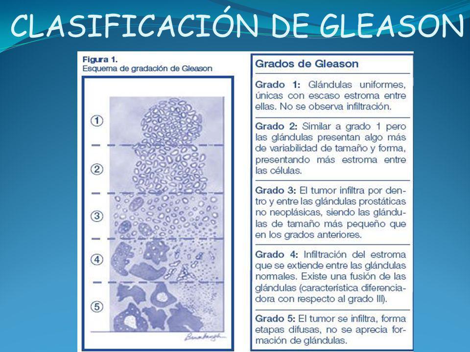 prueba de gleason de la próstata prueba de gleason de la próstata